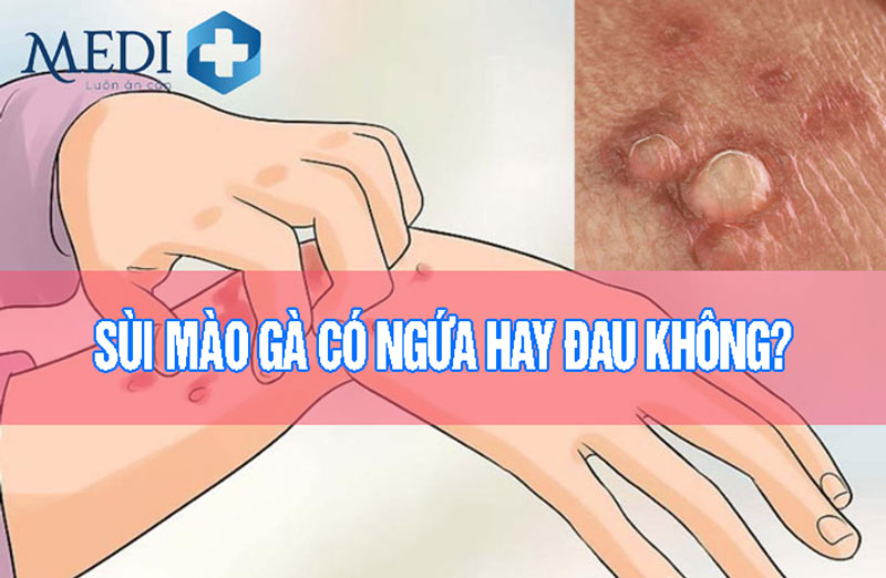 Sùi mào gà có ngứa không? Mụn sùi gây đau hay thế nào?