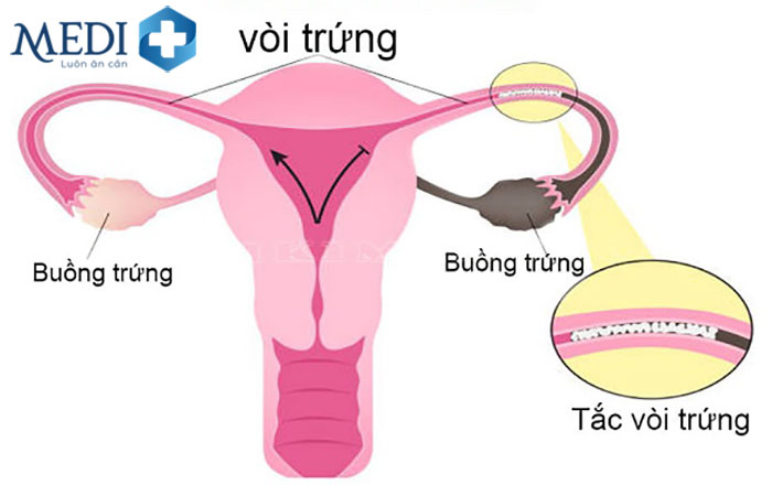 Tắc vòi trứng là tình trạng một hoặc cả hai vòi trứng bị hẹp hay co lại