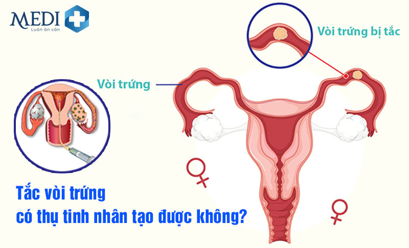 Tắc vòi trứng có thụ tinh nhân tạo được không? Chuyên gia giải đáp