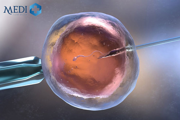 Thụ tinh trong ống nghiệm IVF là như thế nào? Những điều bạn cần biết