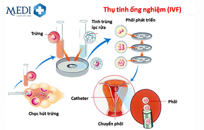 Thụ tinh trong ống nghiệm IVF là phương pháp hỗ trợ sinh sản cho những cặp vợ chồng vô sinh thứ phát