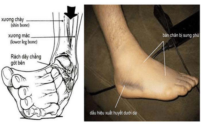 Đau mu bàn chân do rách dây chằng gây khó khăn trong vận động