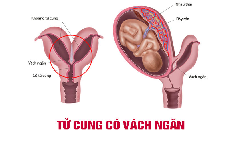 Tử cung có vách ngăn liệu có thai được không?