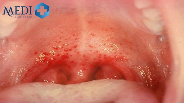 Viêm họng hạt do virus có triệu chứng tương tự như viêm họng thông thường