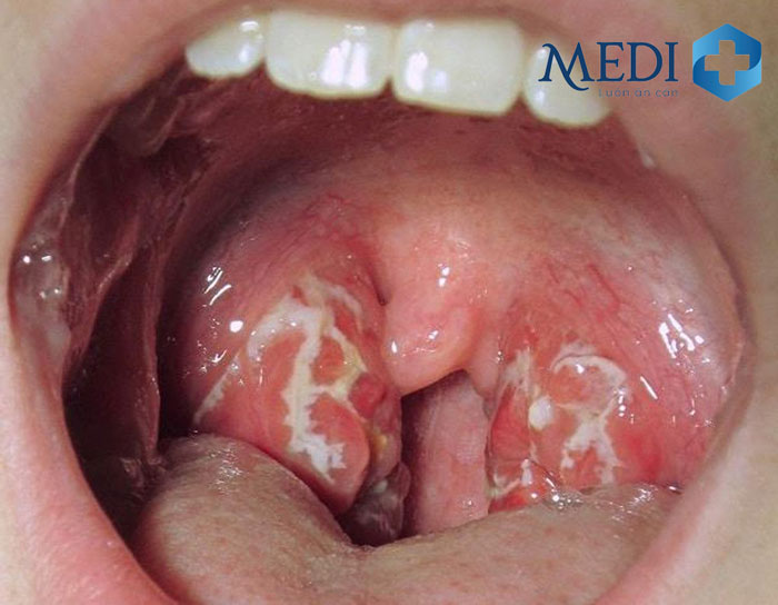 Viêm họng hạt là sự viêm nhiễm kéo dài khiến niêm mạc họng bị tổn thương
