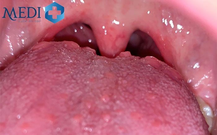 Viêm họng hạt ở lưỡi là dạng khá nguy hiểm của viêm họng hạt