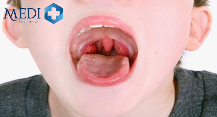 Viêm họng hạt ở trẻ em nếu không điều trị sớm sẽ chuyển sang giai đoạn nhiễm trùng