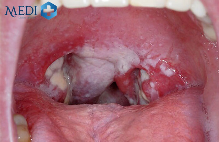 Vòm họng nổi hạch hoặc mảng trắng là đặc điểm nhận diện viêm họng hạt do vi khuẩn
