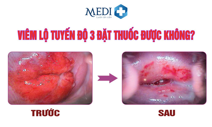 Viêm lộ tuyến độ 3 đặt thuốc có khỏi không?