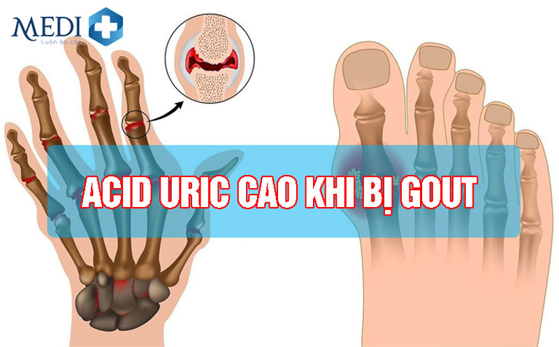 Chỉ số Acid uric cao bao nhiêu thì bị gout?