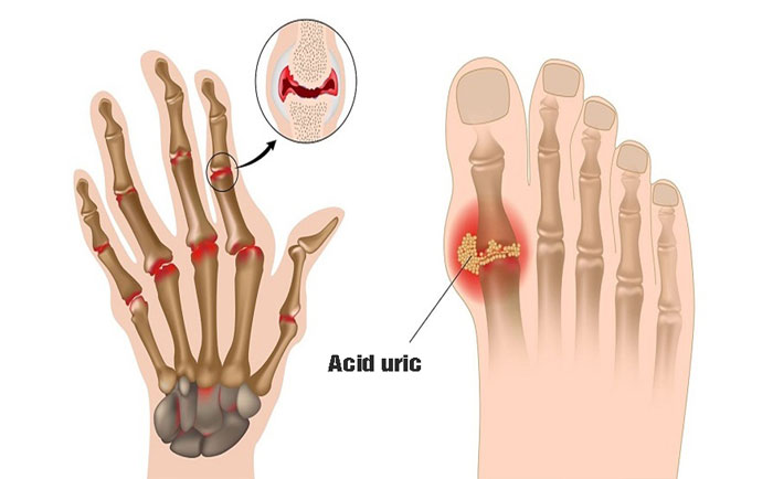 Lượng tinh thể axit uric cao dễ gây ra những cơn đau gout cấp tính