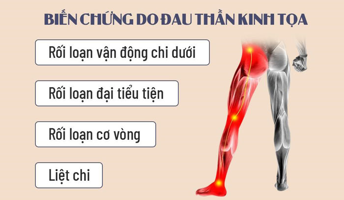 Biến chứng do đau thần kinh tọa