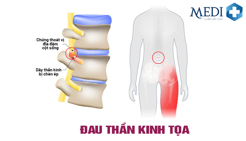 Đau dây thần kinh tọa là gì? Biến chứng bại liệt chi dưới