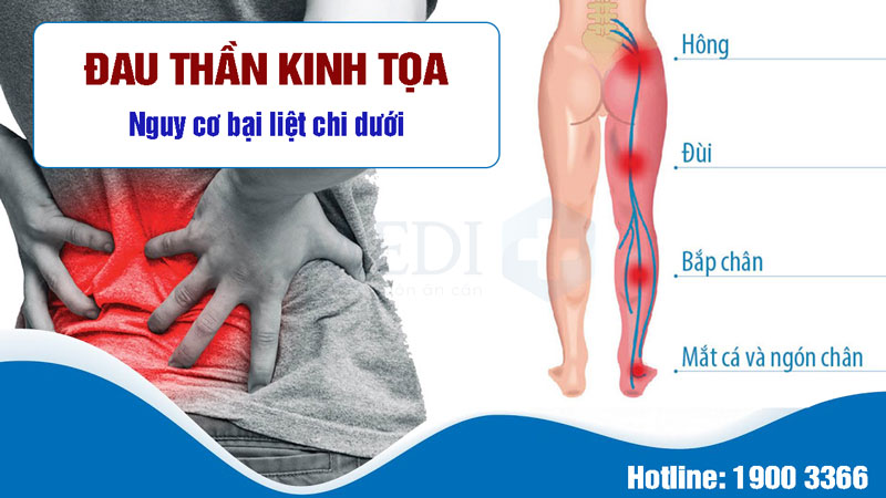 Đau dây thần kinh tọa là gì? Biến chứng bại liệt chi dưới