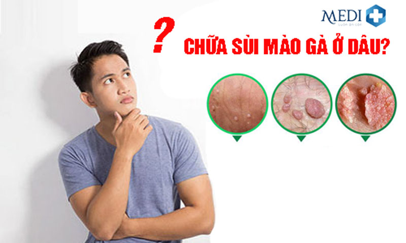 Chữa sùi mào gà ở đâu uy tín và “kín đáo”?