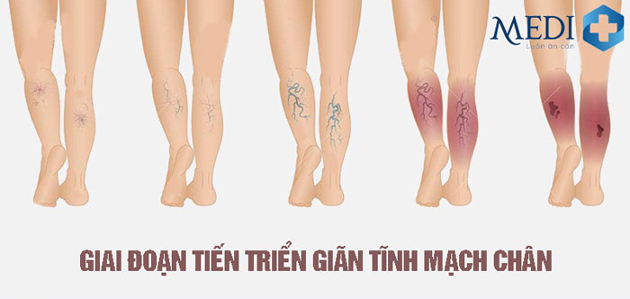 Diễn tiến giãn tĩnh mạch chân ở các giai đoạn có triệu chứng khác nhau.