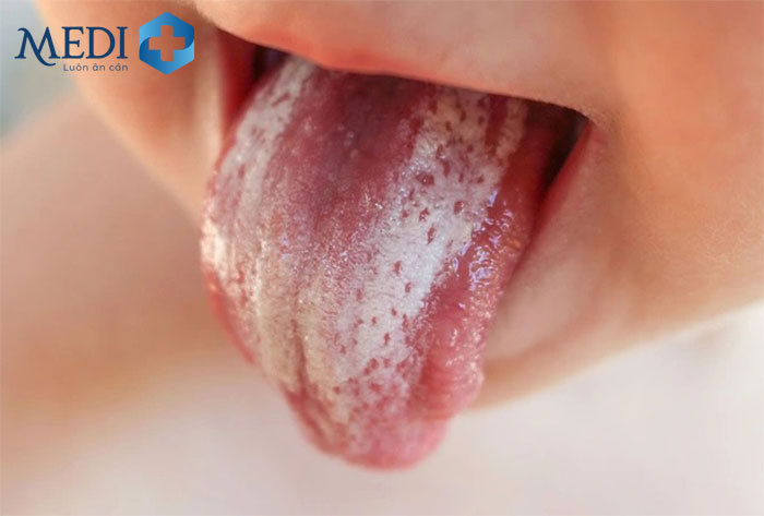 Trẻ xuất hiện các mảng trắng ở lưỡi khi bị nấm