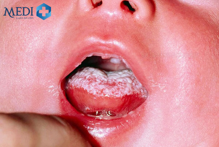 Việc nhiễm nấm gây nứt khóe miệng và chảy máu ở trẻ