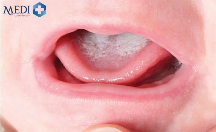 Nấm miệng làm trẻ rất khó khăn khi nhai nuốt thức ăn do tổn thương bên trong