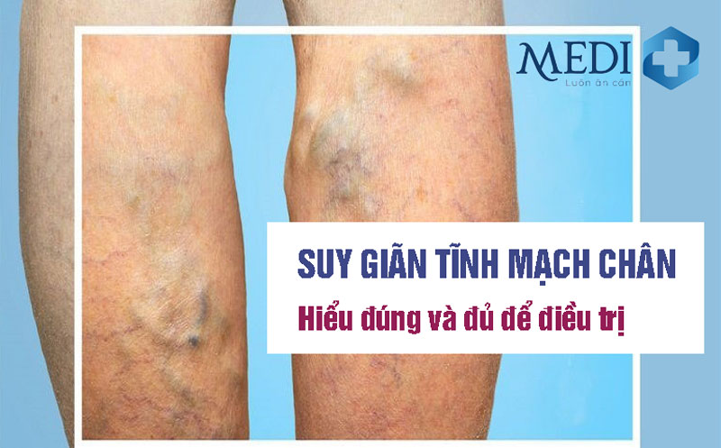 Suy giãn tĩnh mạch chân là bệnh gì? Có nguy hiểm không?