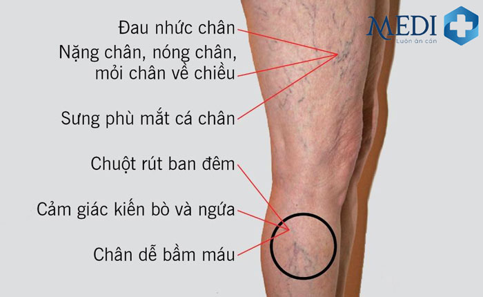 Giãn tĩnh mạch chi dưới gây cảm giác đau nhức, chuột rút về đêm, sưng phù mắt cá chân.