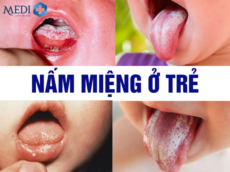 Nấm miệng ở trẻ nhỏ những điều mẹ cần biết và mẹo chữa dân gian