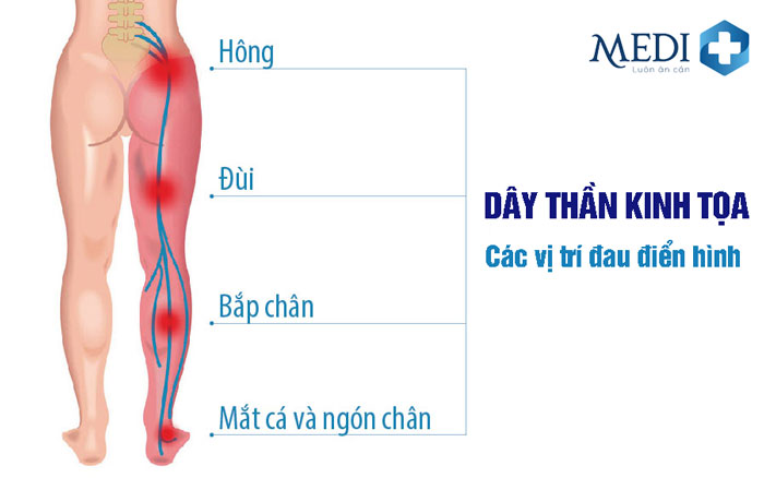 Đau thần kinh tọa là cơn đau lan dọc từ thắt lưng tới cẳng chân hoặc ngón chân.