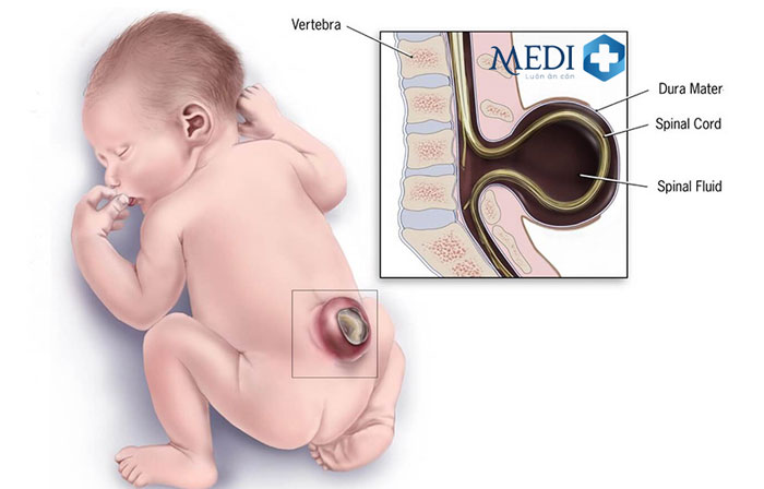 Chọc nước ối chẩn đoán vấn đề gai đôi cột sống s1 ở thai nhi.