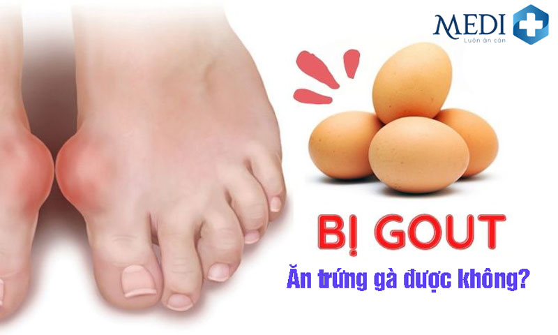 Bệnh gút có ăn được trứng gà không? [HỎI ĐÁP]