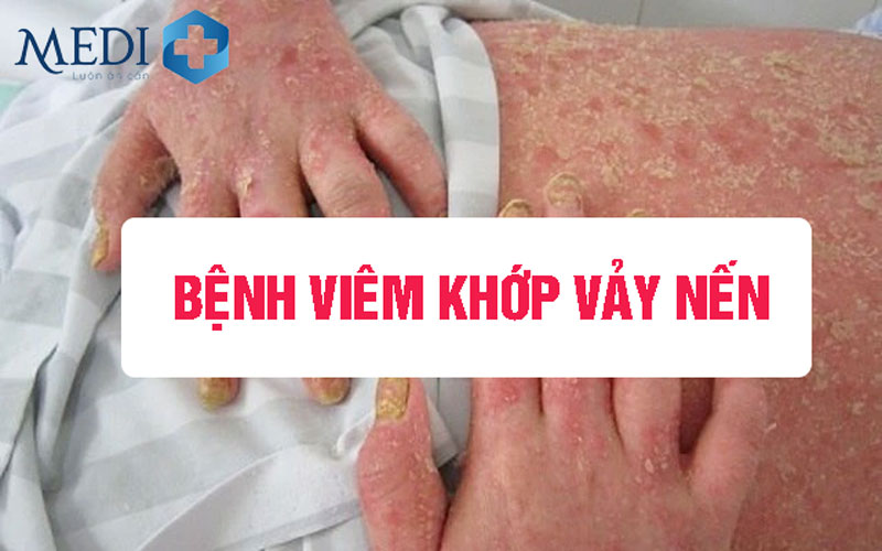 Viêm khớp vảy nến triệu chứng thường gặp và biến chứng