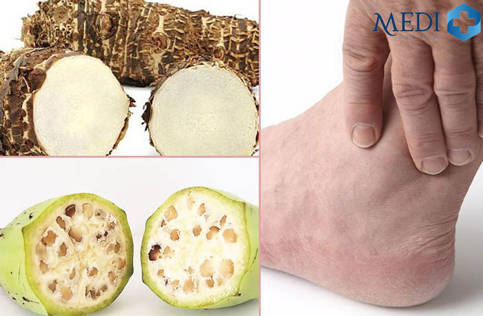 Chữa bệnh gout bằng củ ráy