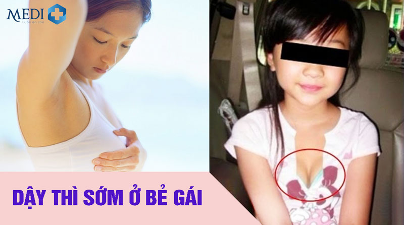 Dấu hiệu nhận biết dậy thì sớm ở bé gái bố mẹ không được bỏ qua