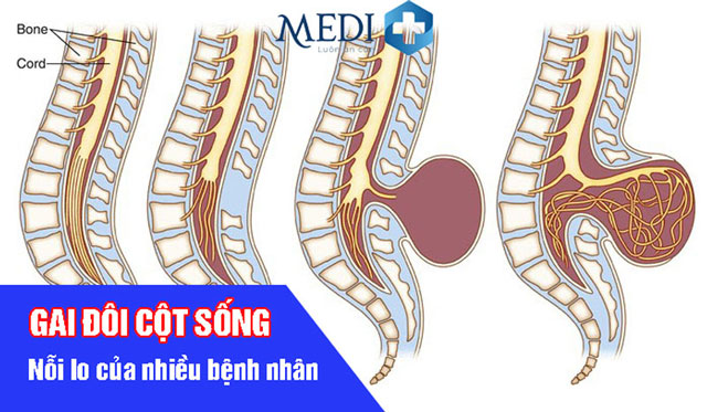 Gai đôi cột sống S1 có nguy hiểm không?