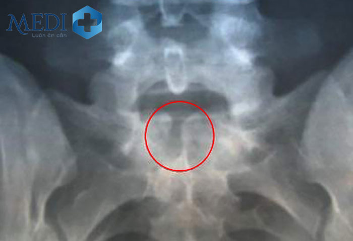 Bị gai đột cột sống s1 - Hình ảnh chụp X quang.