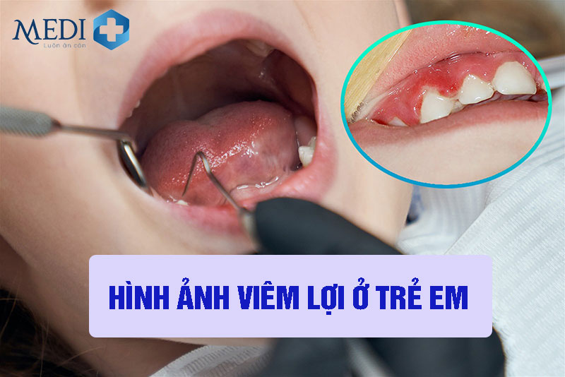 Hình ảnh viêm lợi ở trẻ em: Dấu hiệu và cách điều trị