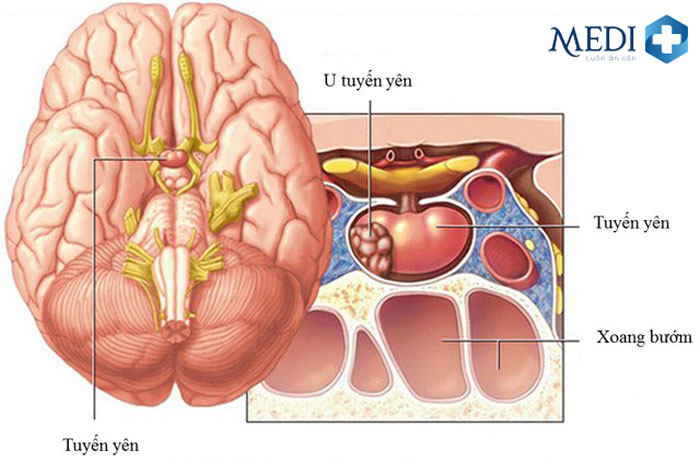 Khối u tuyến yên hay u vùng dưới đồi là nguyên nhân gây tăng prolactin.