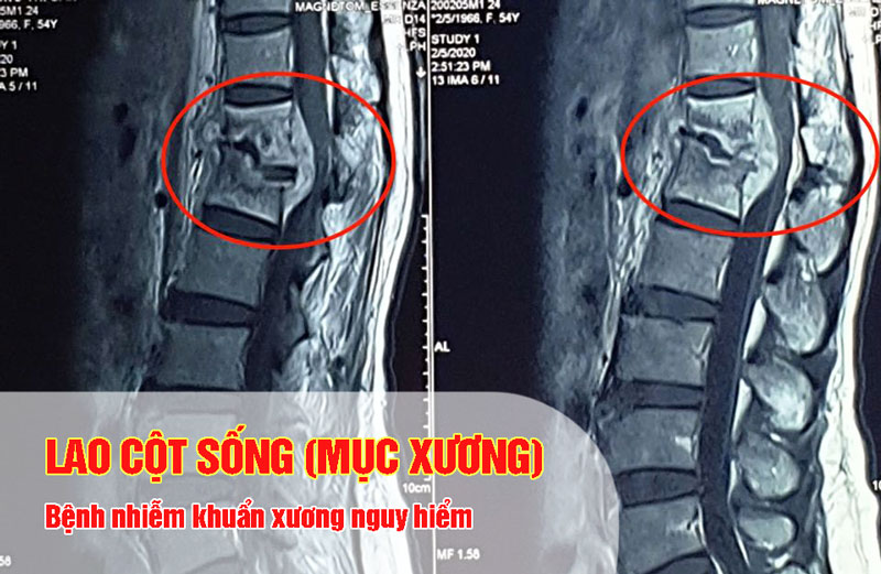 Lao cột sống bệnh lý nhiễm khuẩn xương khớp nguy hiểm