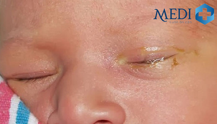 Mắt sưng đỏ khó mở mắt gây viêm khó chịu cho trẻ.