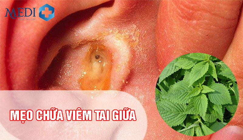 Mẹo chữa viêm tai giữa cho bé tại nhà – NHỎ MÀ CÓ VÕ 