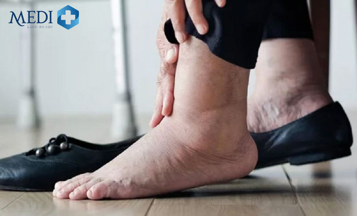 Phù chân có thể là dấu hiệu của bệnh lý