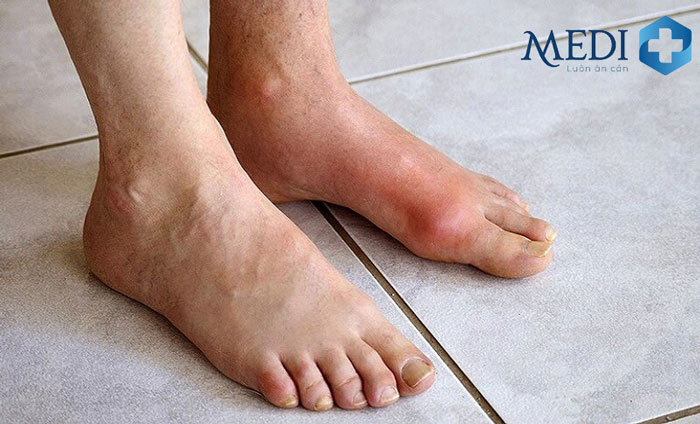 Chân bị sưng phù và đỏ lên do bị bệnh gout ở nhiều đối tượng.