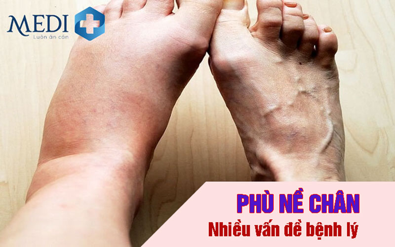 Phù nề chân là bệnh gì, có nguy hiểm không? Một số cách giảm sưng đau