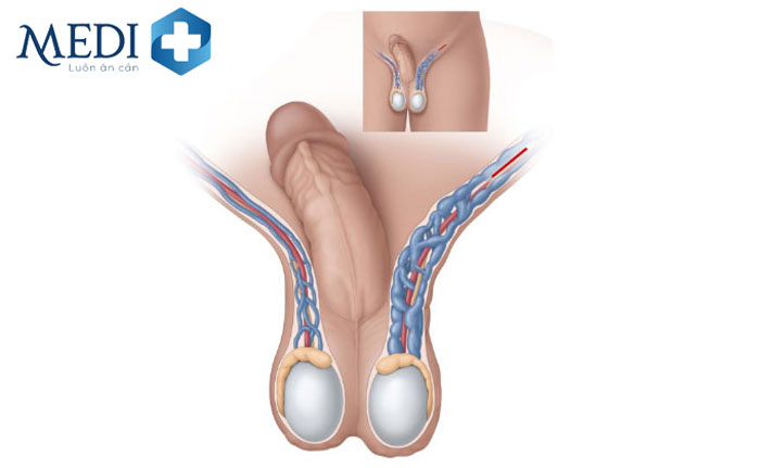 Giãn tĩnh mạch thừng tinh là tĩnh mạch phía trên tinh hoàn bị giãn ra.