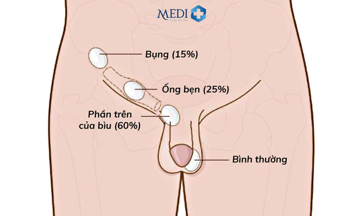 Tinh hoàn ẩn có thể dẫn đến vô sinh cho nam giới.