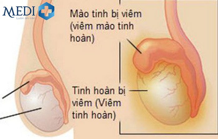 Viêm tinh hoàn do sự xâm nhập của vi khuẩn hoặc virus.