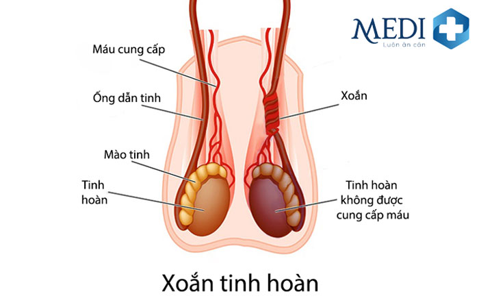 Xoắn tinh hoàn làm giảm lưu lượng máu.