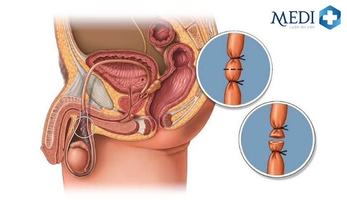 Thắt ống dẫn tinh đạt được tỷ lệ thành công cao gần như tuyệt đối.