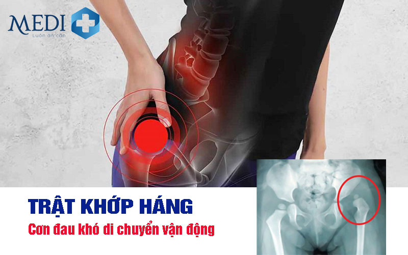 Trật khớp háng (hông) gây đau tổn thương khó di chuyển