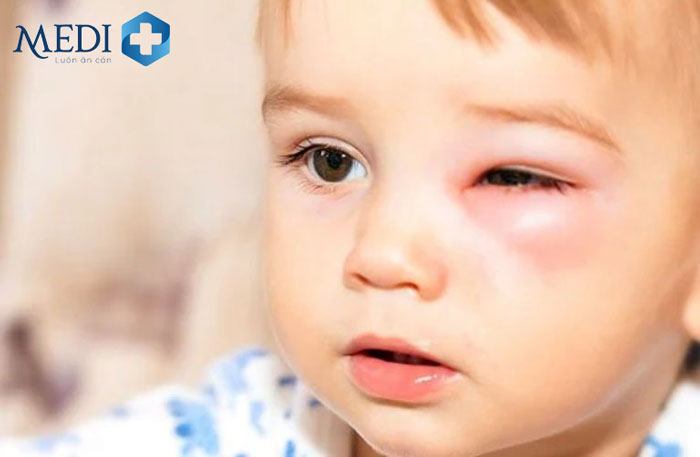 Trẻ bị dị ứng thuốc khiến cho một bên mắt sưng đỏ khó chịu.
