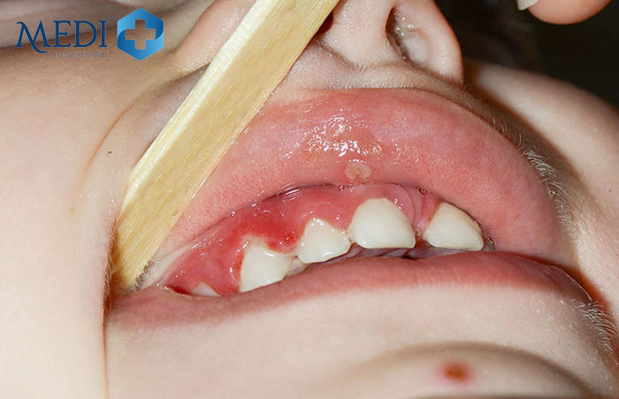 Trẻ bị viêm lợi do vi khuẩn herpes xâm nhập khoang miệng.